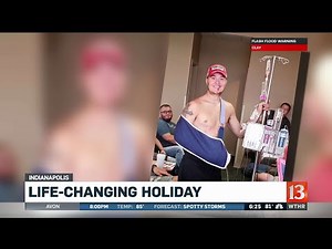 Firework Injury Lost Hand 620