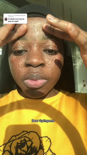 Understanding Syringoma: Symptoms, Causes, and Treatment Options