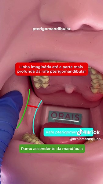 Aprenda a Técnica Anestésica do Nervo Alveolar Inferior