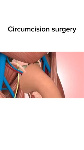 Surgical Animation on Instagram: "Follow @surgicalpovs for more! "