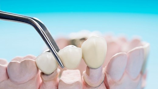 Bridge dentaire : pose, tarifs et remboursement, durée de vie