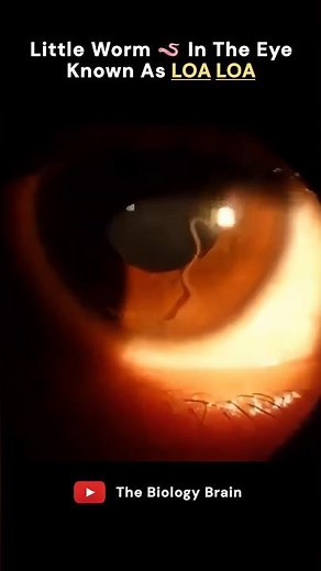 I Had WORMS Crawling in My EYE?! (Loa Loa Nightmare)