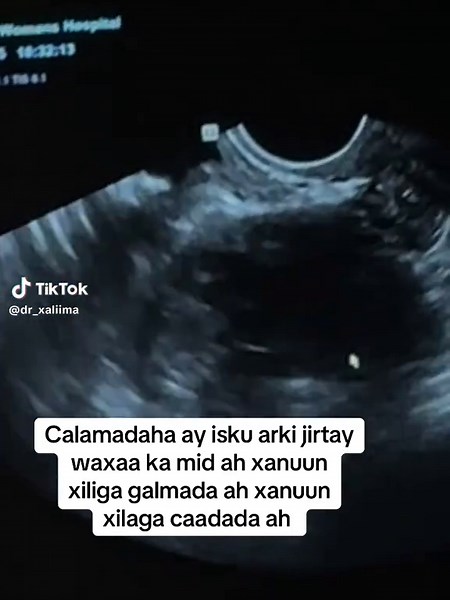 Caafimaadka Haweenka: Calaamadaha Xanuunka Galmada