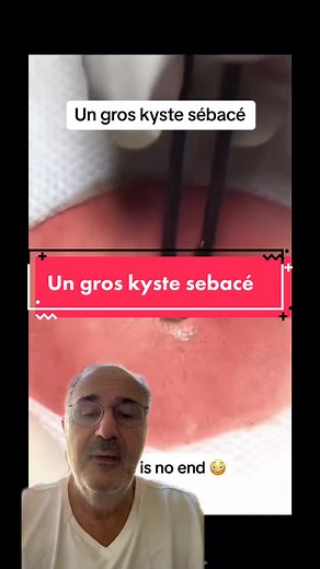 Un gros kyste sebacé #kyste #kystesebace #pimple #pimplepop #viralvideo ##viralmedical #consult #consultation #sante #medecine #medicale #medicalstudent #lovemyjob #medicaltiktok #health #medical #medicalschool #cardio #dermato
