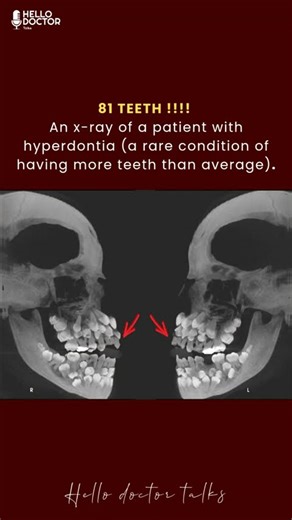 81 TEETH !!!! An x-ray of a patient with hyperdontia rare condition of having more teeth #health