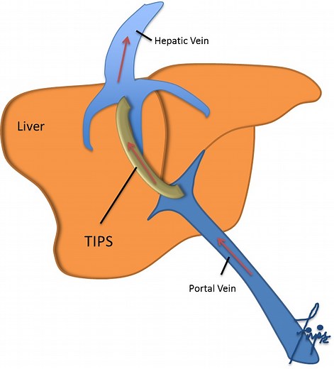 TIPS (Shunt): Transjugular Intrahepatic Portosystemic Shunt (TIPS) » TIPS (Shunt) » Division of Gastroenterology, Hepatology & Nutrition » College of Medicine » University of Florida