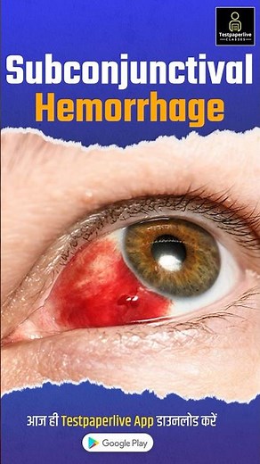 Subconjunctival Hemorrhage (Blood in Eye) #Subconjunctival #hemorrhage #Eye