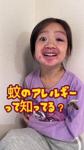 蚊アレルギーの悲劇: 顔が腫れてしまった話