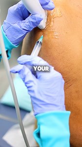 Frozen shoulder can feel like your arm just gave up on moving.A corticosteroid injection can help reduce inflammation and make physical therapy easier.Less pain = better movement.Relief starts with the right treatment! #frozenshoulder #painmanagement #painrelief | Precision Care Medical & Sports Performance