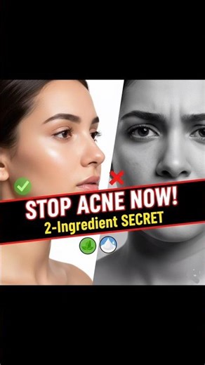 DIY NEEM + CURD: ACNE ERASER!#shorts #shortsfeed #homeremedies #trending #acne #pimples #neem #curd