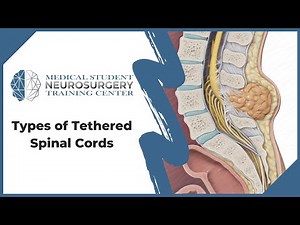 Types of Tethered Spinal Cords