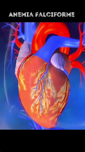 A anemia falciforme é uma doença genética que afeta a hemoglobina, causando a formação de células vermelhas do sangue em forma de foice. Estas células anormais são menos flexíveis e mais frágeis, levando à anemia crônica e obstrução dos vasos sanguíneos, resultando em crises de dor e danos aos tecidos. Causas - Genética: Hereditária autossômica recessiva; necessita de duas cópias do gene defeituoso para a manifestação da doença. Sintomas - Crises de Dor: Episódios intensos devido à obstrução vas