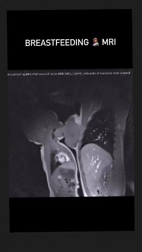 🤱🏽Breastfeeding MRI 🤱🏽 This is a beautiful, unique & priceless research video that shows real time MRI of Breastfeeding 🤱🏽. I will use this next week in class to explain the suction and swallowing reflex of newborns and importance of early bonding interventions and of course benefits of breastfeeding. This video is part of a paper published in 2020 entitled Imaging the breastfeeding swallow: pilot study utilizing real-time MRI You can perfectly see the mandibular movements, palate elevatio