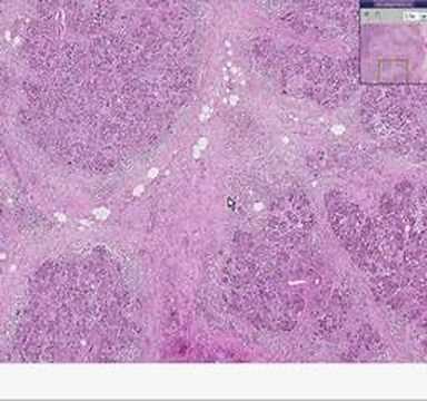 Histopathology Pancreas -- Adenocarcinoma