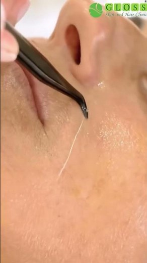 Watch Collagen Threads Lift & Glow Instantly