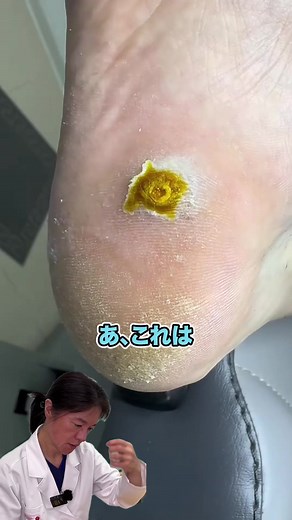 魚の目治療とタコに関する情報