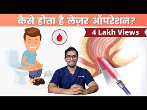 Piles/Fissure/Fistula - Laser Surgery Procedure explained | Dr. Vishal Tomar | Open Consult