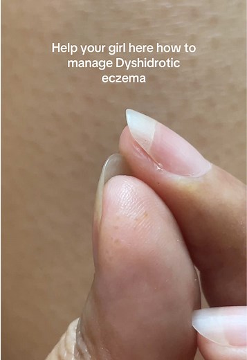 Manage Dyshidrotic Eczema: Simple Stress-Linked Tips