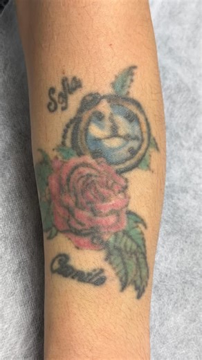 Color tattoo removal on the forearm is where technique truly matters. Each pigment reacts to a different wavelength, which means safe and effective removal requires multiple wavelengths, advanced technology, and precise calibration. In a visible and delicate area like the forearm, every parameter must be carefully selected to break down the ink while keeping the skin 100% intact. This is not trial and error — it’s controlled, professional laser work backed by knowledge and experience. Because wh