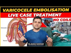 Live Varicocele embolisation case 2 | Without any metal coils | Dr. Gaurav Gangwani (IR)