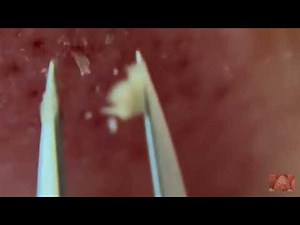 nose blackheads removal with tweezers