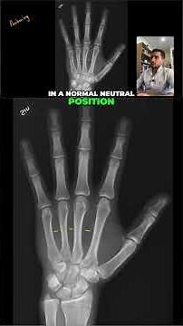 Position, Area, and Collimation for a HAND X-Ray
