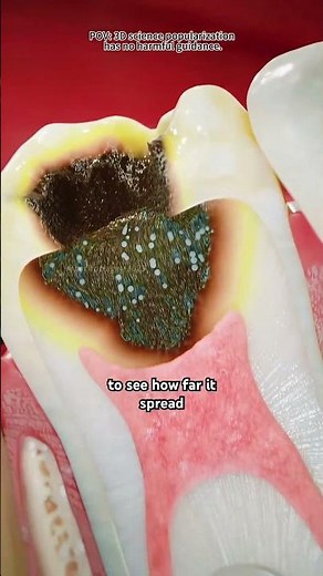 Root Canal Treatment (3D Animation)