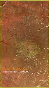 14K views · 179 reactions | Old central retinal vein occlusion (ischemic) : @retinography #retina #oftalmo #ophthalmology #oftalmologia #oftalmología #ophtalmologie #офтальмологія #офтальмология #οφθαλμολογία #retinography2025 #CIRRUS6000 #CLARUS700 #ZEISSRETINAWORKFLOW | OPTOMETRISTS | Facebook
