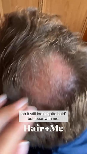 Begin your hair regrowth journey today with a personalised treatment plan – all you have to do is: • Answer a few questions 📝 • Snap a few photos 📸 • Use your treatment daily 🗓 | Hair Me