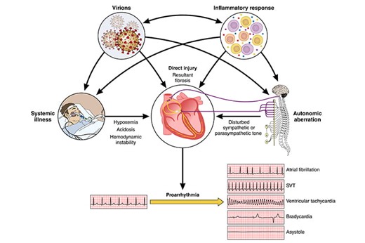 Cardiac Arrhythmias and Autonomic Dysfunction Associated With COVID-19