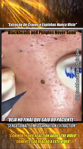 ✅Extraction of Blackheads and Pimples Never Seen✅ ✅Squeezing Blackheads on Face✅ 🎬If you liked the Video Blackheads and Pimples Comment Your Reaction on the Video 💖🤳 Follow, Like and Share to help bring more videos. #acne #cravos #blackheads #pimplepop #pimples #squeezeyuk #satisfying #videoviral #cravosgigantes #extractionsatisfaciton #estetica