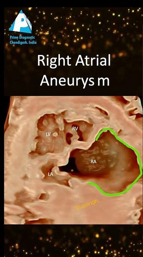 Fetal Right Atrial Aneurysm ❤️ | Rare Prenatal Echo Finding You Must See!