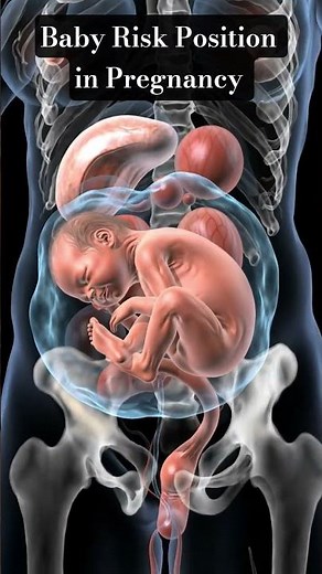 Baby Risk Position in Pregnancy | Breech & Transverse Position Explained #pregnancy #shorts #baby