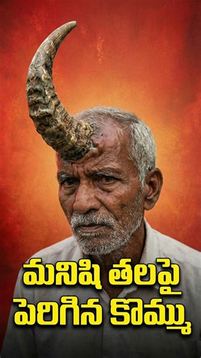 Real-Life Human With Horn 😨 | Shocking Medical Truth #facts #humanbody #shorts