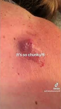 Giant Chunky Cyst Full Blown Squirter!!!!