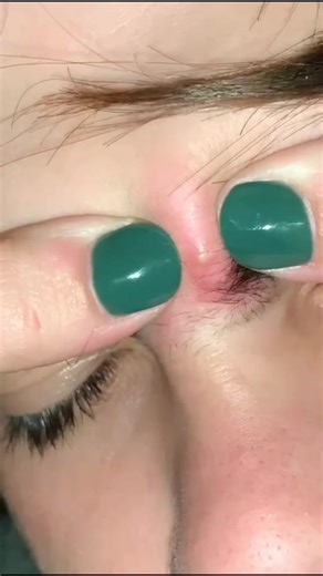 #pimplepop #pimplepopper #extraction #acne #pimples #satisfying #granos #blackheads #blackheadsremoval