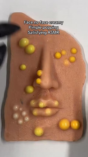 A lot of infected pimples Satisfyilng？？？？？#asmrsounds ... #viral #asmr | Mochi Pimple Popper Visual ASMR