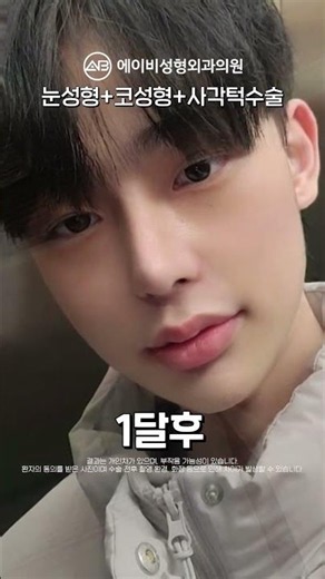 남자눈성형+코성형+사각턱수술 3달 후기 #shorts