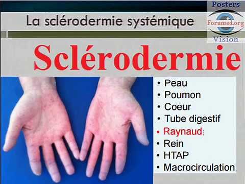 Sclerodermie systémique: Symptomes et Pronostic