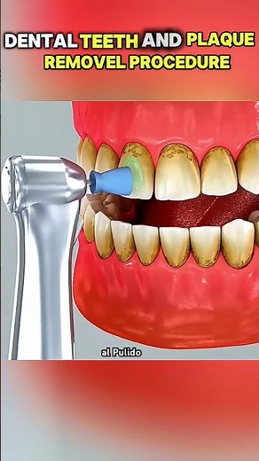 Dental teeth and plaque removal surgery ( 3-D Animation)#DentalCleaning #PlaqueRemoval #MedicalWorld