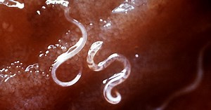 Doctors Are Considering Hookworms As A Treatment For Ulcerative Colitis