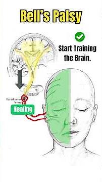 Brain Heals Bell's Palsy before Facial Nerve.
