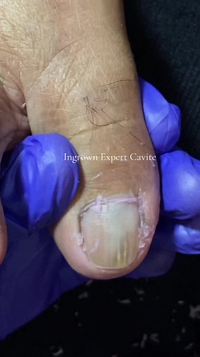 Ingrown Expert Cavite: Your Go-To Solution for Ingrown Hair