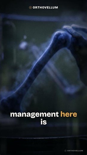 Humeral Shaft Fracture with Wrist Drop: Radial Nerve Palsy Management