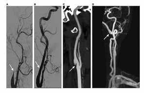 Treatment and Outcomes of Cervical Artery Dissection in Adults