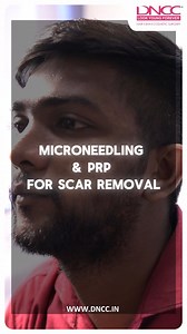 Microneedling and PRP treatment for scar removal can revive your skin...