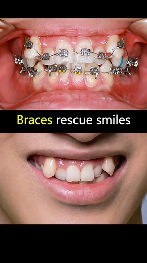 64K views · 296 reactions | Braces fix crooked teeth. Rescue his smile ##braces #orthodontist #smile #teeth #dentist | Daily Deep Clean | Facebook