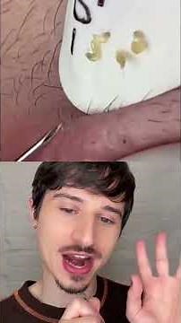 #dermreacts Lip #blackhead removal. #skincare #pimplepopping