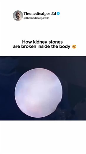 Themedicalpost3d on Instagram: "👉For large kidney stones, PCNL (Percutaneous Nephrolithotomy) is an effective treatment. It breaks the stones into smaller fragments using ultrasonic or pneumatic lithotripters and then removes them through a small incision. This minimally invasive procedure offers quick recovery, reduced risk of complications, and high success rates for clearing stones, providing relief from symptoms like pain and infection. #kidneystones #pcnl #medical #biology #fyp #instagood 