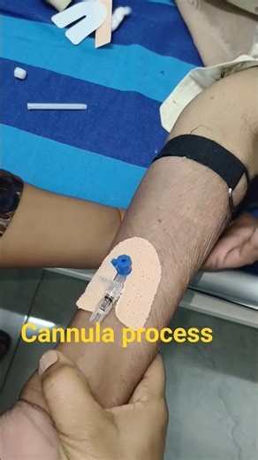 #cannulakaiselagatehain #cannulainsertion #csnnula